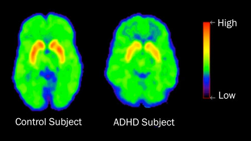 adhd brain